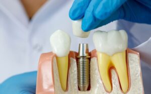 Dentalni implantati