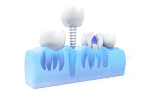 Savremena implantologija