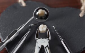 Hirurško vađenje zuba