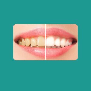 Gingivektomija i gingivoplastika