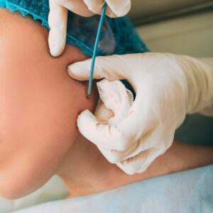 Radio - talasno uklanjanje